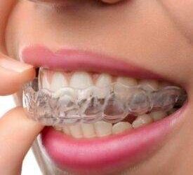 Invisalign in Kochi – Modern Clear Aligner Treatment for Smile Correction