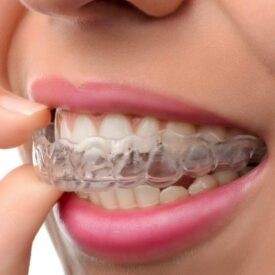 Invisalign in Kochi – Modern Clear Aligner Treatment for Smile Correction